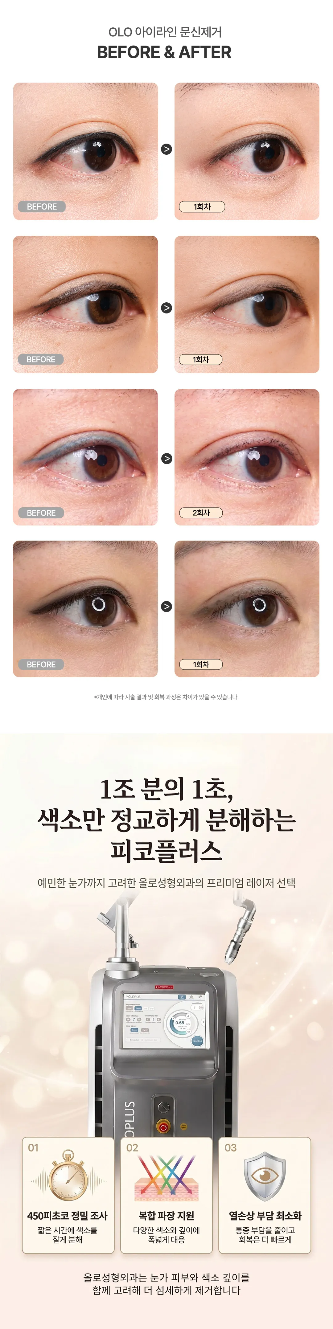 올로성형외과 아이라인 시술 정보